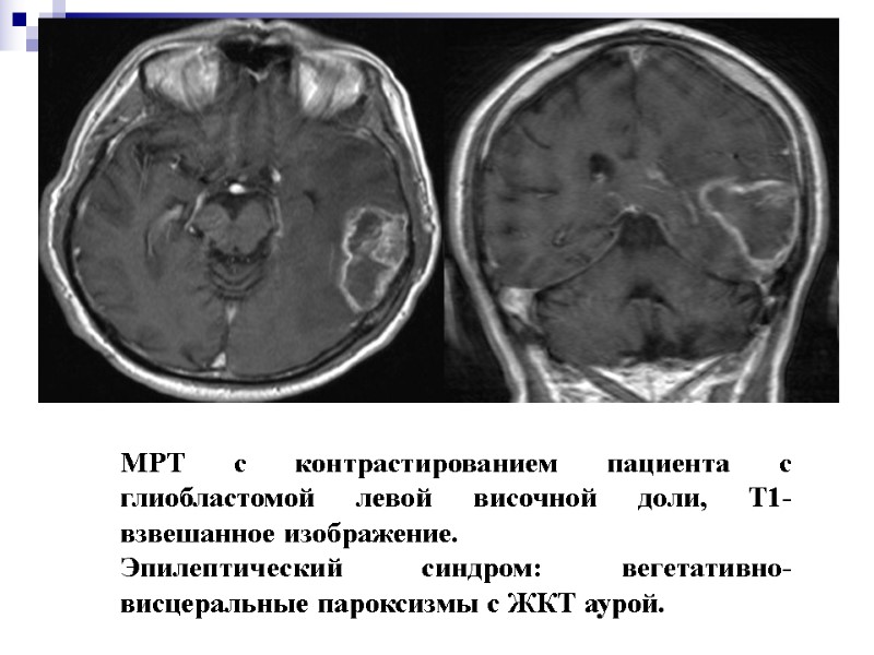 МРТ с контрастированием пациента с глиобластомой левой височной доли, Т1-взвешанное изображение.  Эпилептический синдром: